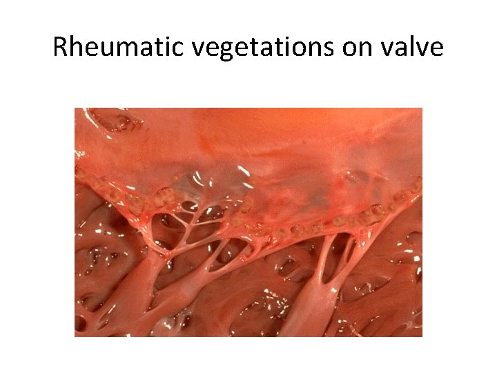 Rheumatic vegetations on valve 