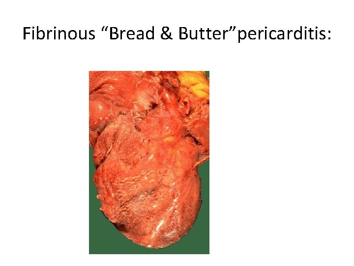 Fibrinous “Bread & Butter”pericarditis: 