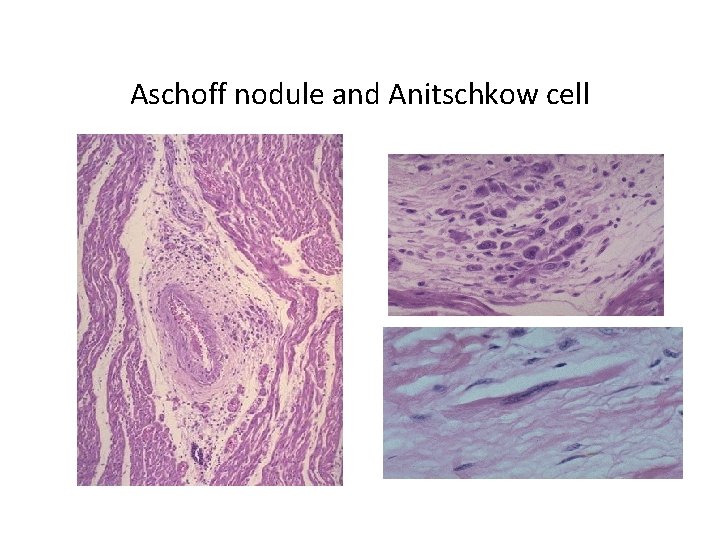 Aschoff nodule and Anitschkow cell 