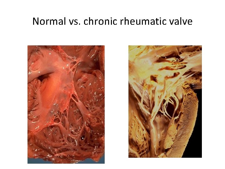 Normal vs. chronic rheumatic valve 