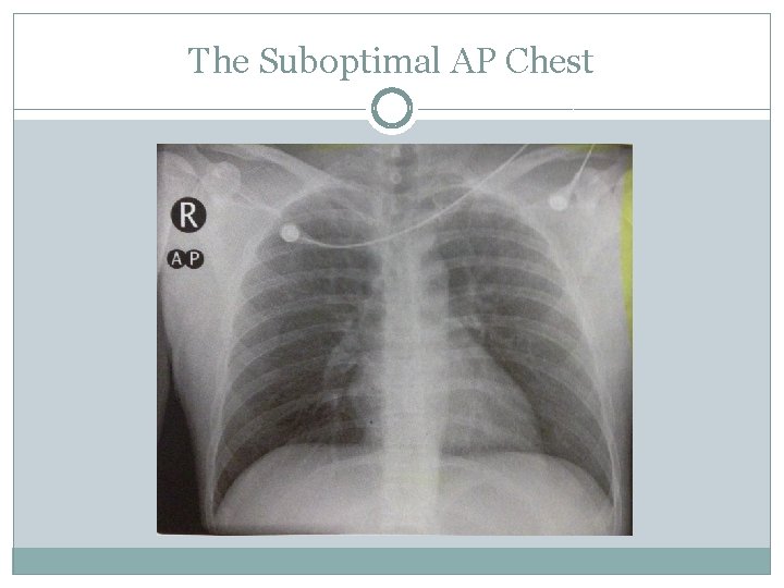 The Suboptimal AP Chest 