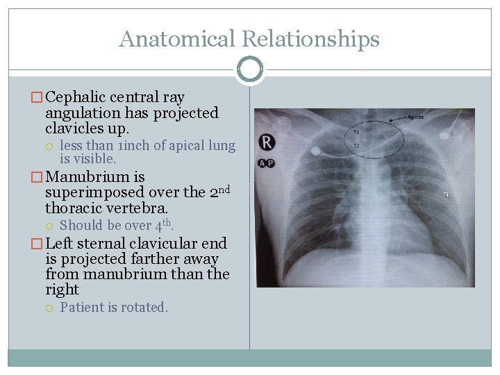 Anatomical Relationships � Cephalic central ray angulation has projected clavicles up. less than 1