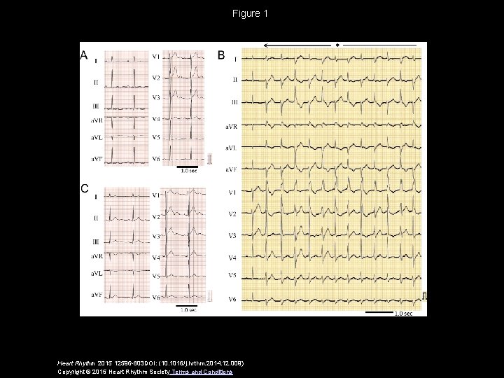 Figure 1 Heart Rhythm 2015 12596 -603 DOI: (10. 1016/j. hrthm. 2014. 12. 009)