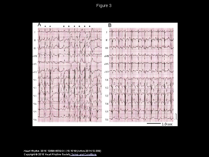 Figure 3 Heart Rhythm 2015 12596 -603 DOI: (10. 1016/j. hrthm. 2014. 12. 009)