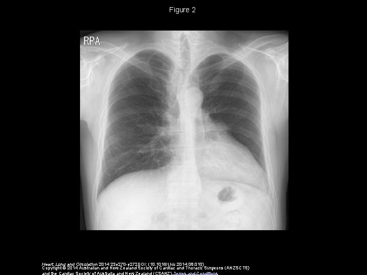 Figure 2 Heart, Lung and Circulation 2014 23 e 270 -e 272 DOI: (10.