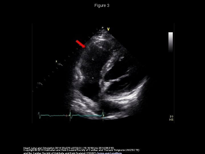 Figure 3 Heart, Lung and Circulation 2014 23 e 270 -e 272 DOI: (10.