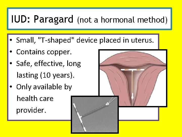 IUD: Paragard (not a hormonal method) • Small, "T-shaped" device placed in uterus. •