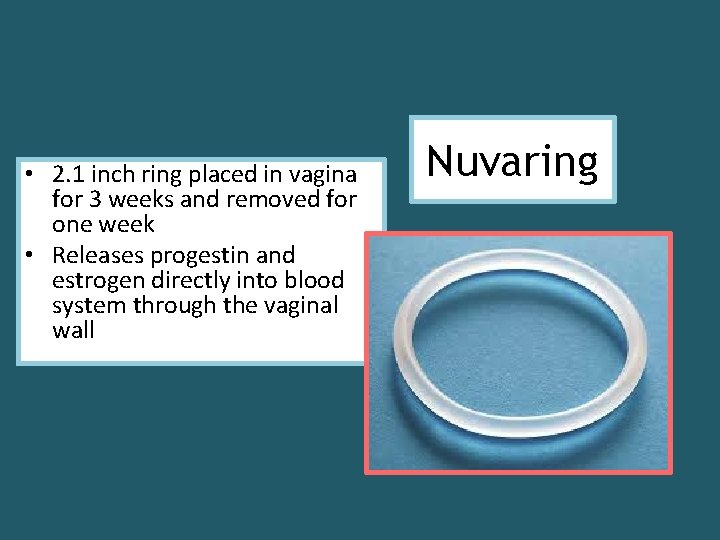  • 2. 1 inch ring placed in vagina for 3 weeks and removed