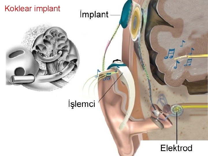 Koklear implant 