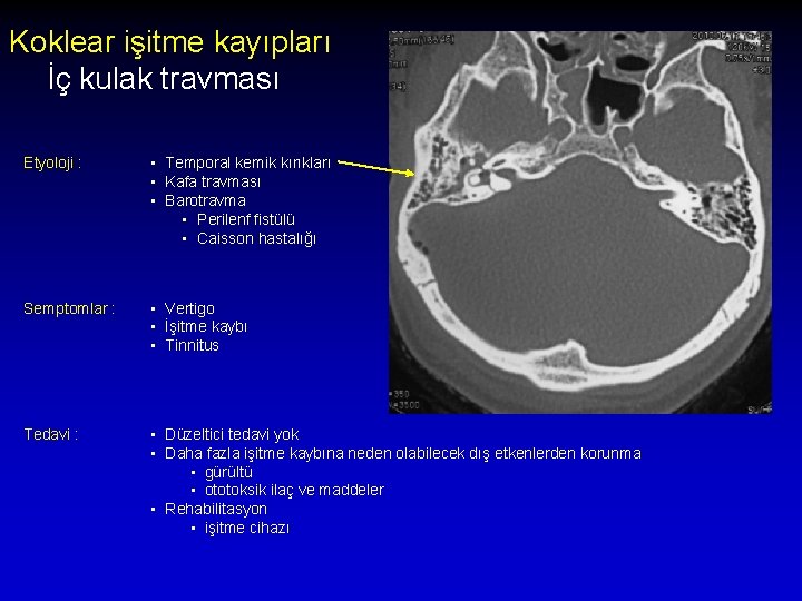 Koklear işitme kayıpları İç kulak travması Etyoloji : • Temporal kemik kırıkları • Kafa