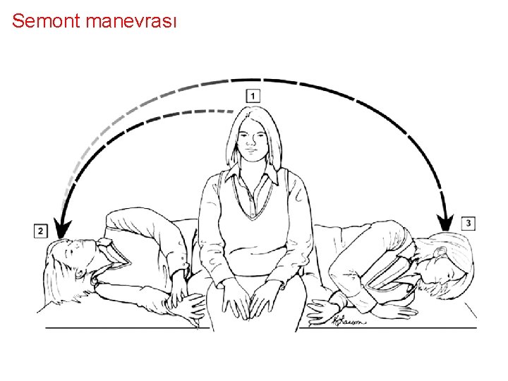 Semont manevrası 