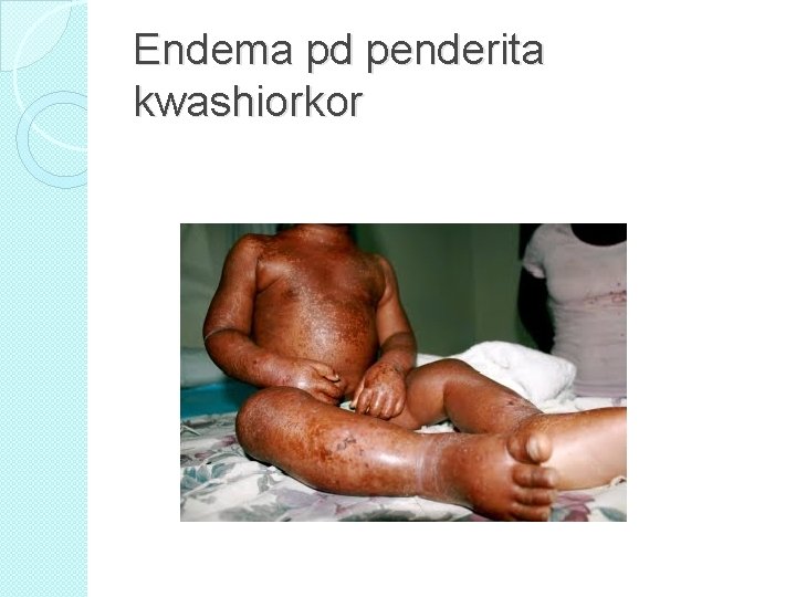 Endema pd penderita kwashiorkor 