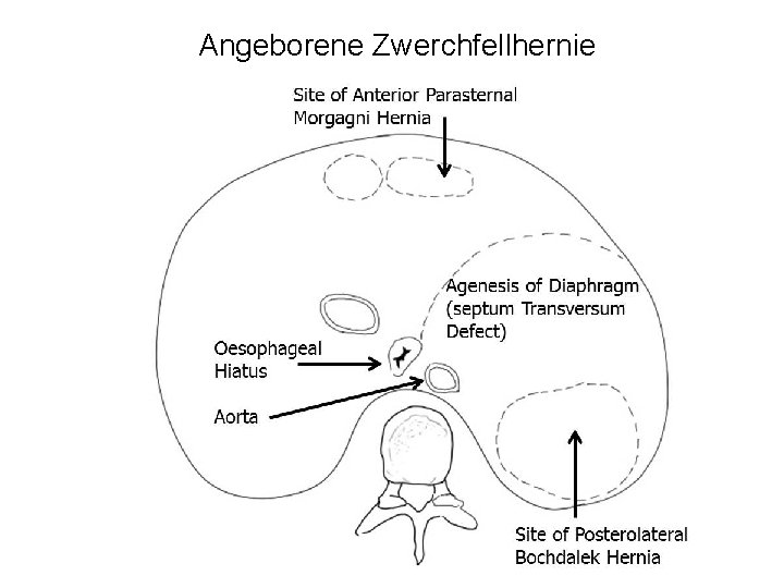 Angeborene Zwerchfellhernie 