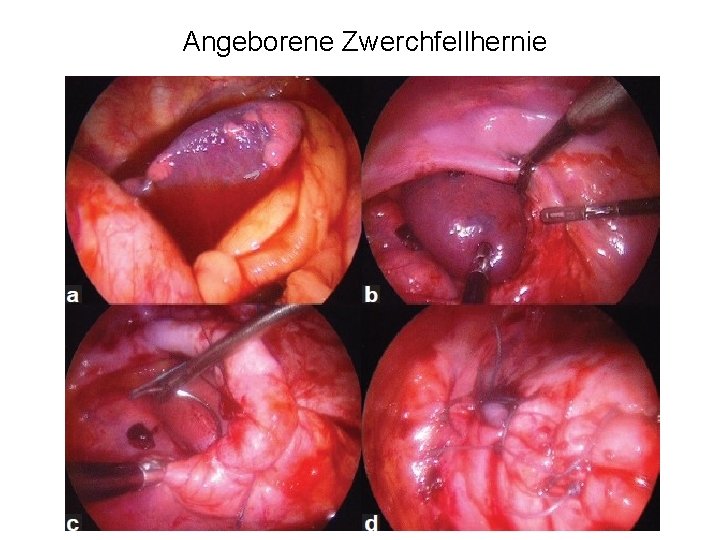 Angeborene Zwerchfellhernie 