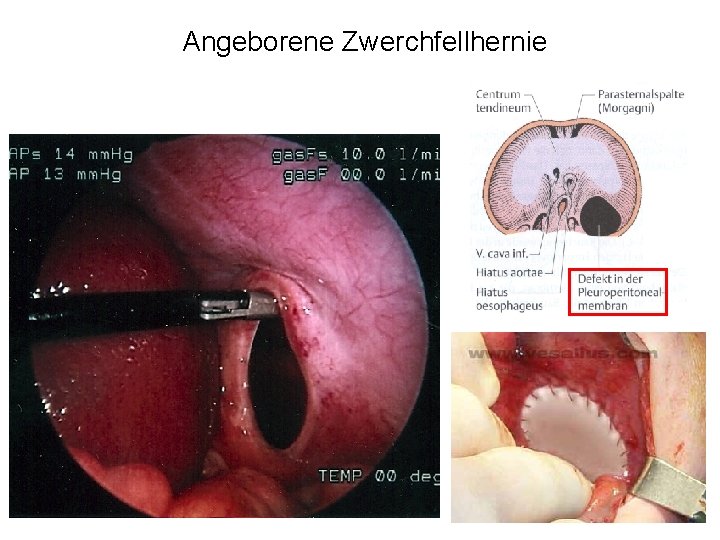 Angeborene Zwerchfellhernie 