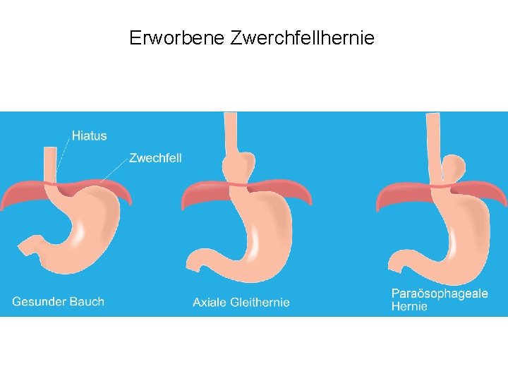 Erworbene Zwerchfellhernie 