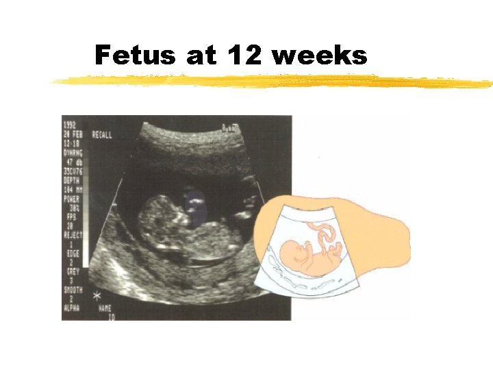 Fetus at 12 weeks 