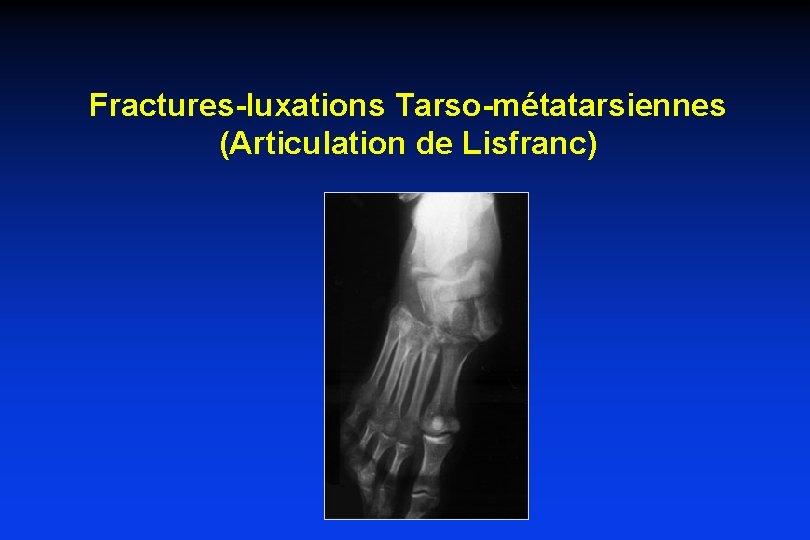 Fractures-luxations Tarso-métatarsiennes (Articulation de Lisfranc) 