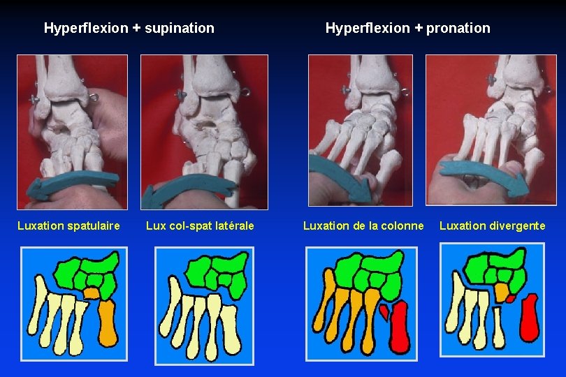  Hyperflexion + supination Hyperflexion + pronation Luxation spatulaire Lux col-spat latérale Luxation de