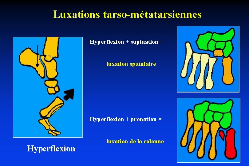 Luxations tarso-métatarsiennes Hyperflexion + supination = luxation spatulaire Hyperflexion + pronation = Hyperflexion luxation