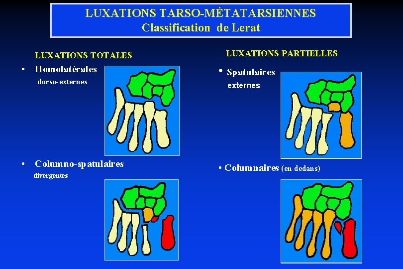 LUXATIONS TARSO-MÉTATARSIENNES Classification de Lerat LUXATIONS TOTALES • Homolatérales dorso-externes • Columno-spatulaires divergentes LUXATIONS