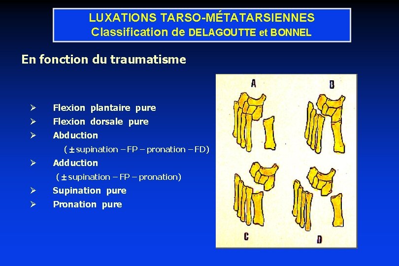 LUXATIONS TARSO-MÉTATARSIENNES Classification de DELAGOUTTE et BONNEL En fonction du traumatisme Ø Flexion plantaire