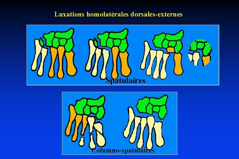 Luxations homolatérales dorsales-externes Spatulaires Columno-spatulaires 