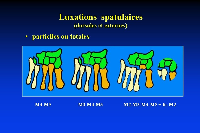 Luxations spatulaires (dorsales et externes) • partielles ou totales M 4 -M 5 M