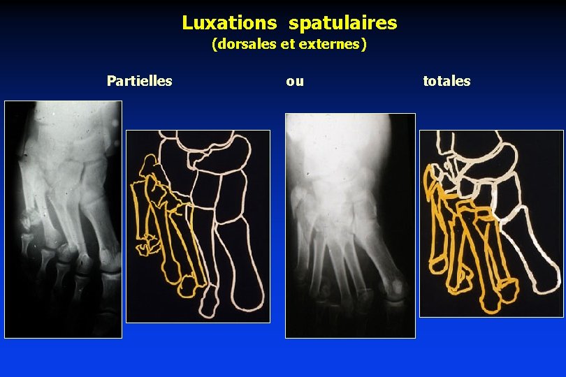 Luxations spatulaires (dorsales et externes) Partielles ou totales 