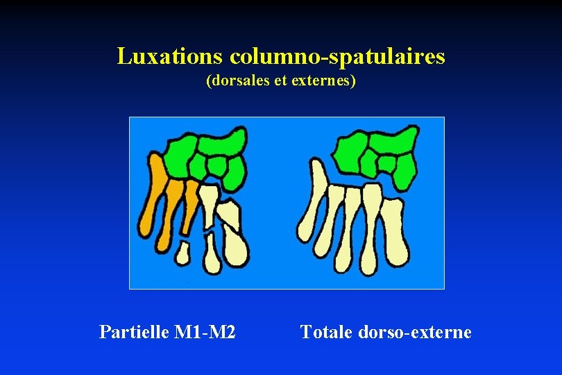 Luxations columno-spatulaires (dorsales et externes) Partielle M 1 -M 2 Totale dorso-externe 