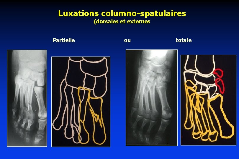 Luxations columno-spatulaires (dorsales et externes Partielle ou totale 