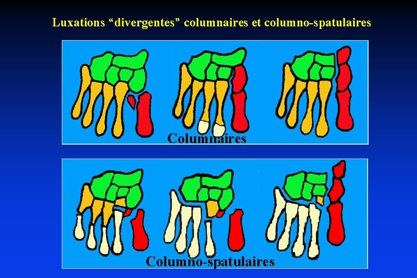 Luxations “divergentes” columnaires et columno-spatulaires Columno-spatulaires 