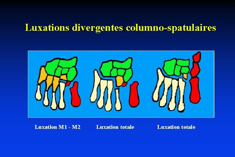 Luxations divergentes columno-spatulaires Luxation M 1 - M 2 Luxation totale 