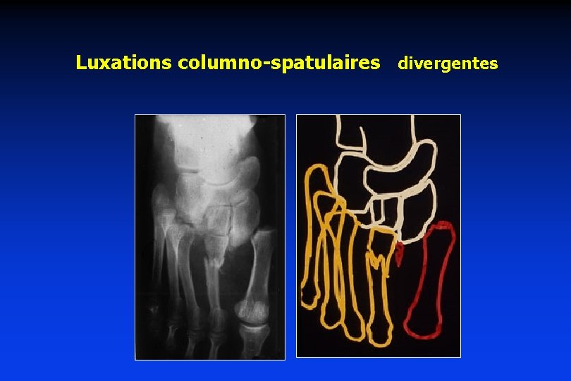 Luxations columno-spatulaires divergentes 