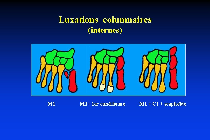 Luxations columnaires (internes) M 1+ 1 er cunéiforme M 1 + C 1 +