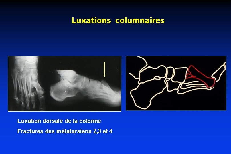 Luxations columnaires Luxation dorsale de la colonne Fractures des métatarsiens 2, 3 et 4