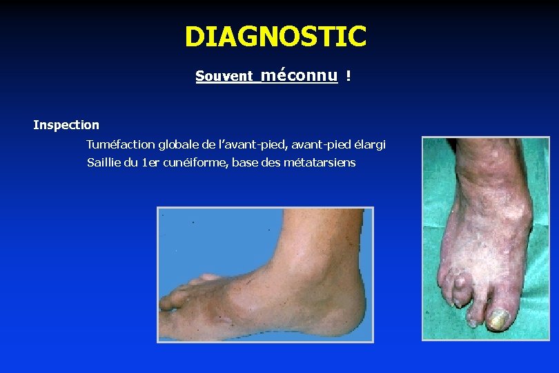 DIAGNOSTIC Souvent méconnu ! Inspection Tuméfaction globale de l’avant-pied, avant-pied élargi Saillie du 1