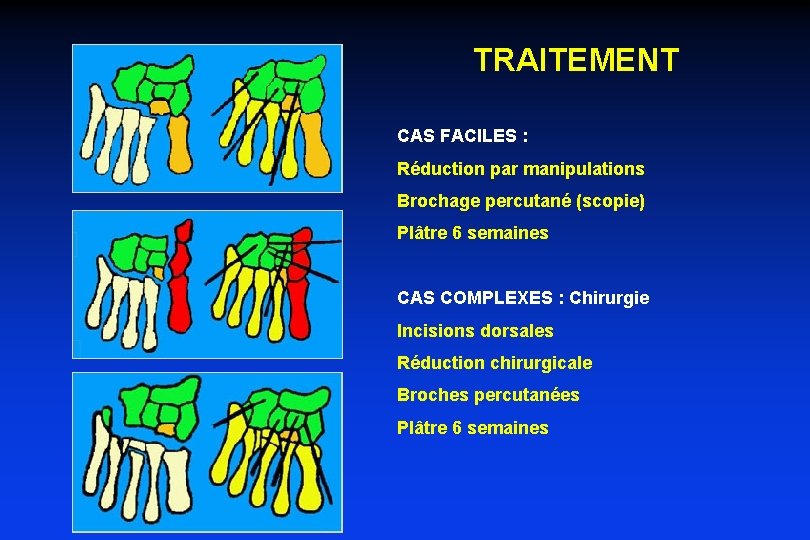 TRAITEMENT CAS FACILES : Réduction par manipulations Brochage percutané (scopie) Plâtre 6 semaines CAS