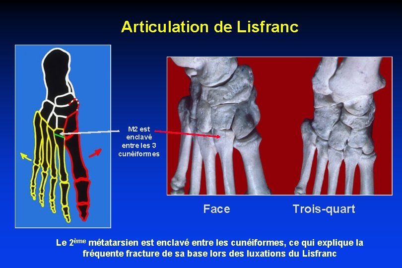Articulation de Lisfranc M 2 est enclavé entre les 3 cunéiformes Face Trois-quart Le