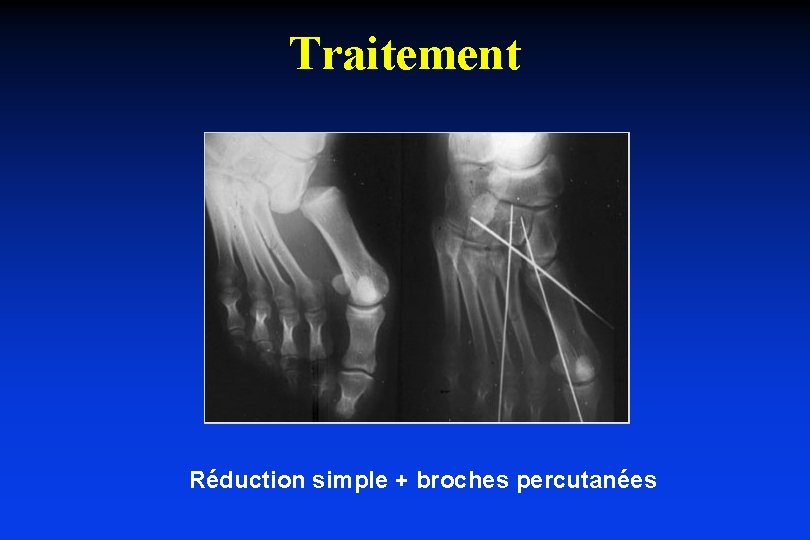 Traitement Réduction simple + broches percutanées 