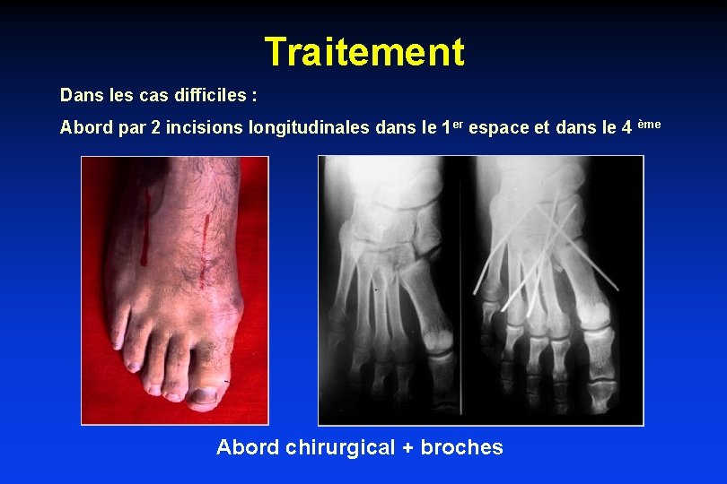 Traitement Dans les cas difficiles : Abord par 2 incisions longitudinales dans le 1