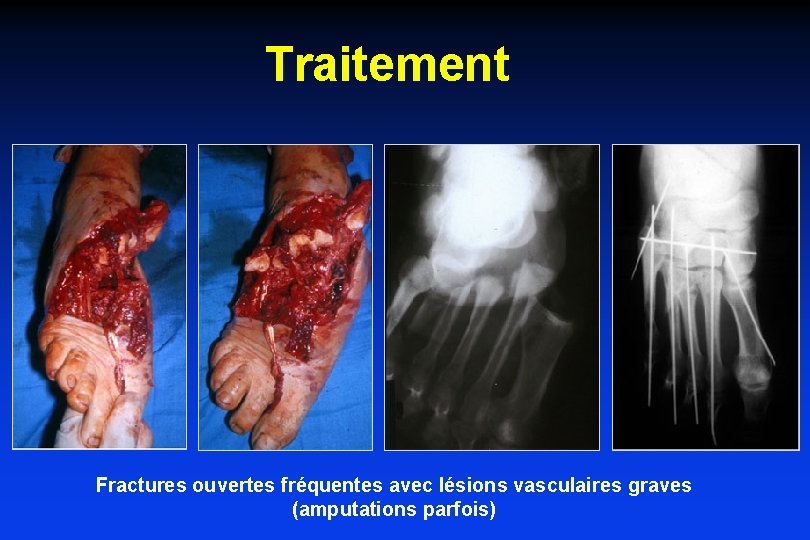 Traitement Fractures ouvertes fréquentes avec lésions vasculaires graves (amputations parfois) 