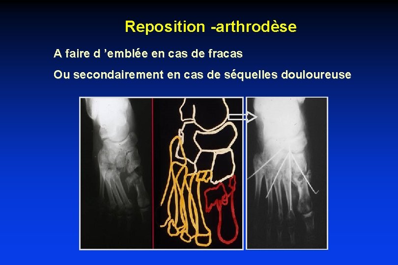 Reposition -arthrodèse A faire d ’emblée en cas de fracas Ou secondairement en cas