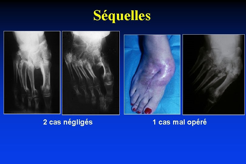 Séquelles 2 cas négligés 1 cas mal opéré 