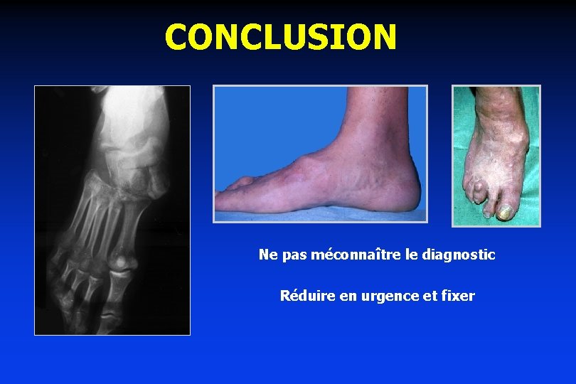 CONCLUSION Ne pas méconnaître le diagnostic Réduire en urgence et fixer 