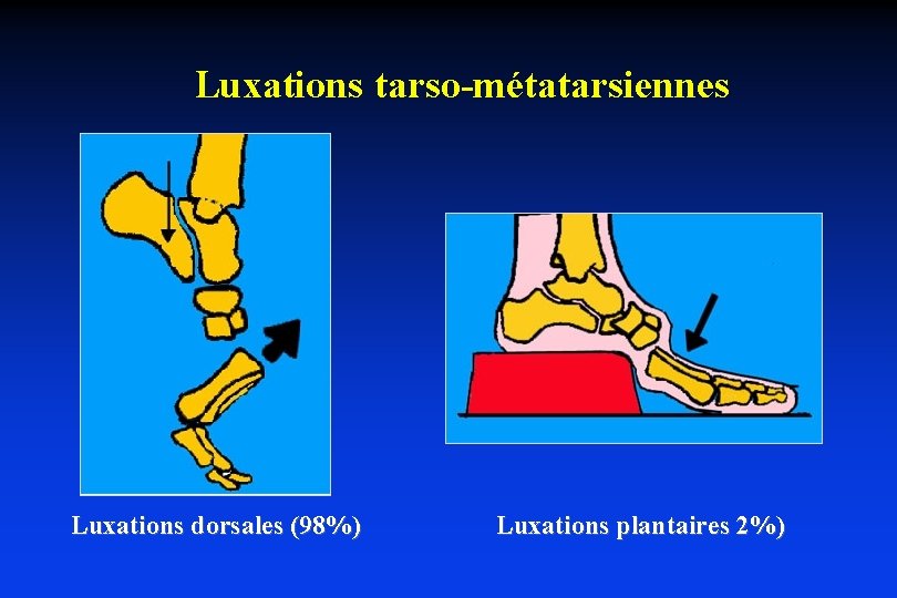Luxations tarso-métatarsiennes Luxations dorsales (98%) Luxations plantaires 2%) 