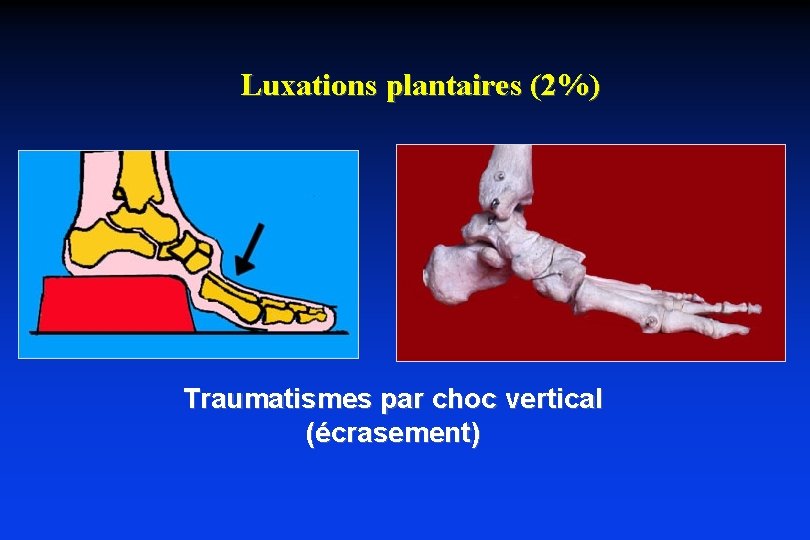 Luxations plantaires (2%) Traumatismes par choc vertical (écrasement) 