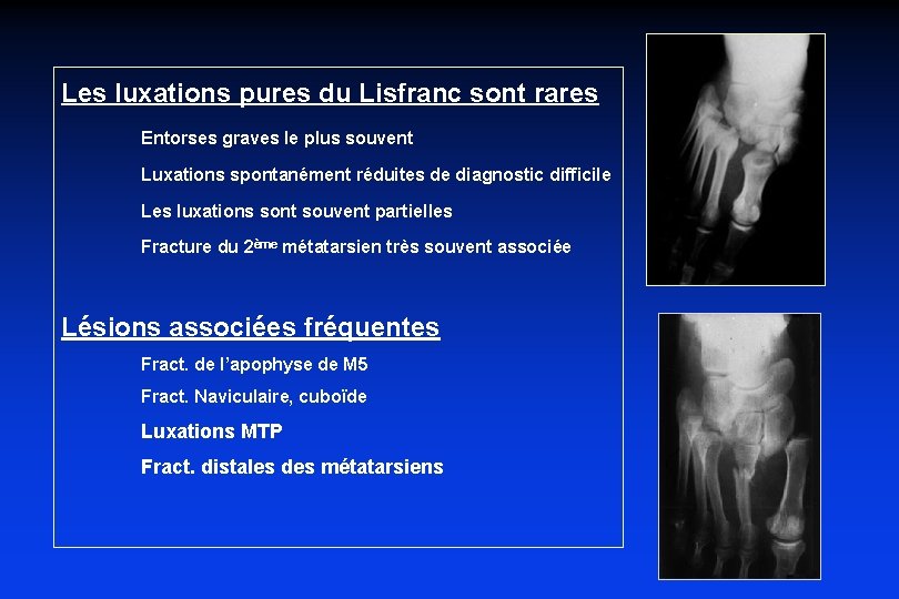 Les luxations pures du Lisfranc sont rares Entorses graves le plus souvent Luxations spontanément
