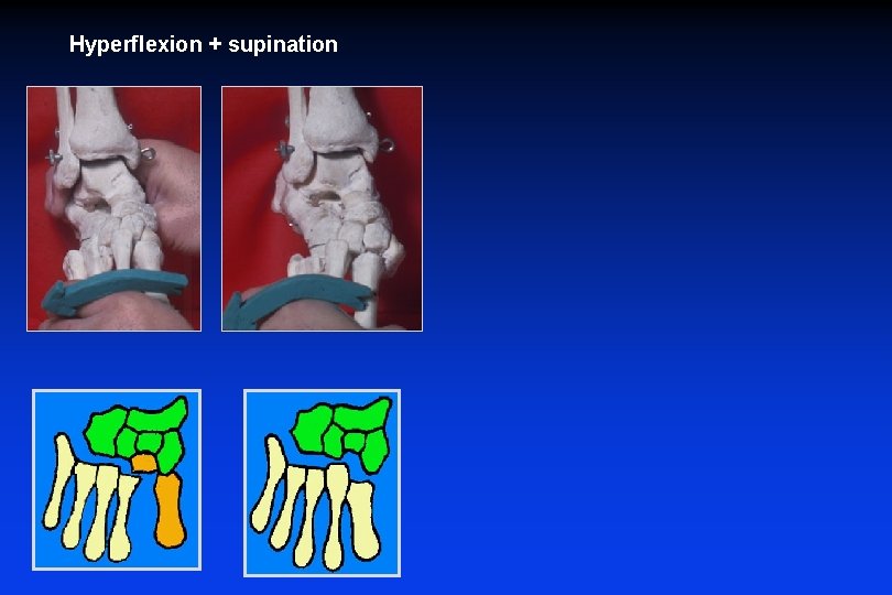  Hyperflexion + supination Luxation spatulaire Lux col-spat latérale 
