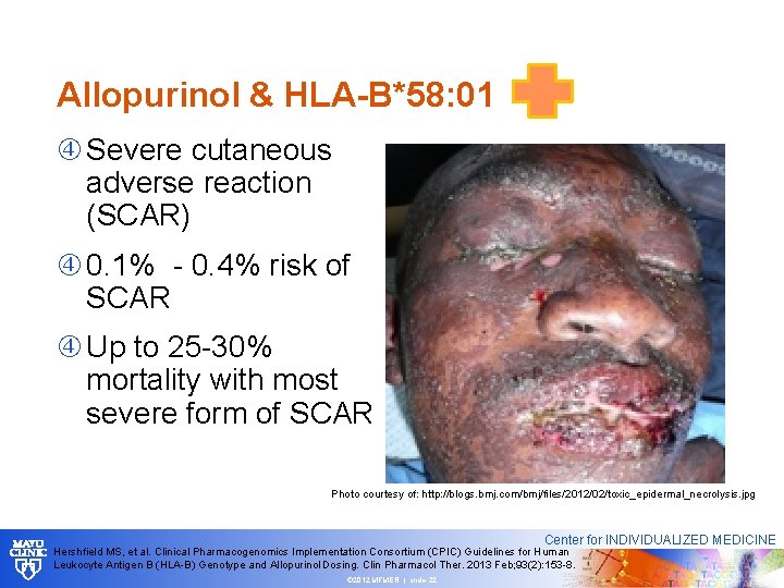 Allopurinol & HLA-B*58: 01 Severe cutaneous adverse reaction (SCAR) 0. 1% - 0. 4%